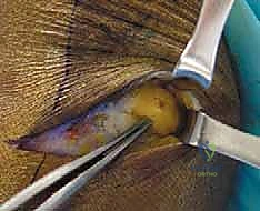 صورة توضيحية لـ تحرير الأعصاب الطرفية: علاج انضغاط العصب الفخذي الجلدي الوحشي والشظوي المشترك في صنعاء مع الأستاذ الدكتور محمد هطيف