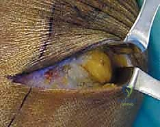 صورة توضيحية لـ تحرير الأعصاب الطرفية: علاج انضغاط العصب الفخذي الجلدي الوحشي والشظوي المشترك في صنعاء مع الأستاذ الدكتور محمد هطيف