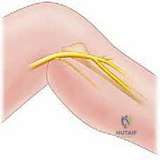 تحرير الأعصاب الطرفية: علاج انضغاط العصب الفخذي الجلدي الوحشي والشظوي المشترك في صنعاء مع الأستاذ الدكتور محمد هطيف