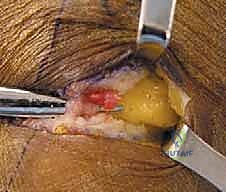 صورة توضيحية لـ تحرير الأعصاب الطرفية: علاج انضغاط العصب الفخذي الجلدي الوحشي والشظوي المشترك في صنعاء مع الأستاذ الدكتور محمد هطيف