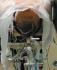 استخدام الأطواق الطبية كعلاج تحفظي مبدئي