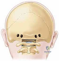 صورة شعاعية بعد الانتهاء من التثبيت الجراحي بنجاح