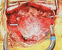 الأربطة الداعمة للفقرات العنقية العلوية
