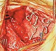 تصوير بالرنين المغناطيسي يوضح الضغط على الحبل الشوكي