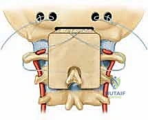 تخطيط ما قبل الجراحة باستخدام الأشعة المقطعية ثلاثية الأبعاد
