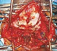 الشق الجراحي والوصول إلى الفقرات المستهدفة