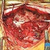 استخدام أجهزة الأشعة التداخلية داخل غرفة العمليات