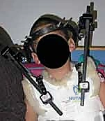 متابعة المريض في العيادة وتقييم تقدم الالتحام العظمي