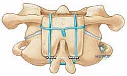 صورة توضيحية لـ تثبيت الفقرات العنقية الخلفي: دليل شامل لدمج الجمجمة-C2 والفقرة C1-C2