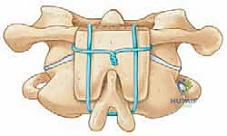 إدخال البراغي في الكتل الجانبية للفقرة الأولى