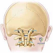 صورة شعاعية قبل وبعد الجراحة لحالة حادث سير