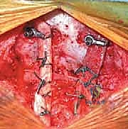 وضع الطعوم العظمية لتحفيز الالتحام