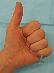 Flexor Tendon Tenolysis: An Intraoperative Masterclass for Restoring Digital Function