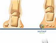 صورة توضيحية لتشوه القدم الجوفاء من المنظر الأمامي، تُظهر انحراف الكعب للداخل