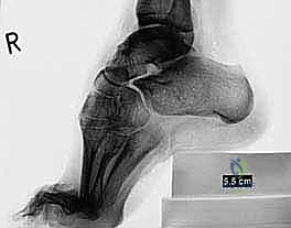 ميكانيكية العضلات المؤثرة على تشوه القدم