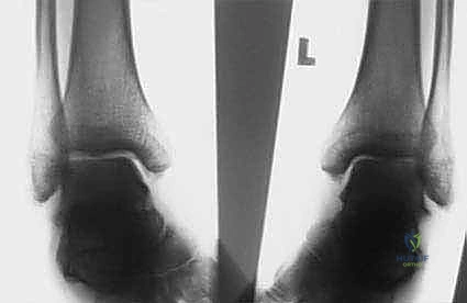 تأثير العضلات الشظوية على شكل القدم