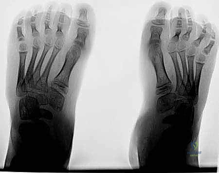 التغيرات العظمية في مفصل الكاحل والقدم