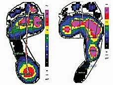 التشوهات الهيكلية مجهولة السبب في القدم