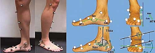 مواضع الألم ومسامير اللحم في القدم الجوفاء