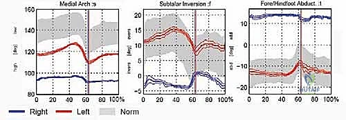 تقييم مرونة القدم سريرياً