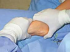 صورة طبية: القدم الحنفاء الجوفاء الروحاء دليلك الشامل للعلاج مع الأستاذ الدكتور محمد هطيف في صنعاء