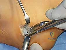 صورة توضيحية لـ القدم الحنفاء الجوفاء الروحاء دليلك الشامل للعلاج مع الأستاذ الدكتور محمد هطيف في صنعاء