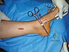 صورة طبية: القدم الحنفاء الجوفاء الروحاء دليلك الشامل للعلاج مع الأستاذ الدكتور محمد هطيف في صنعاء