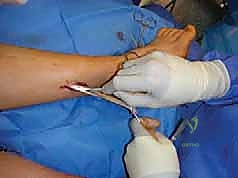 صورة طبية: القدم الحنفاء الجوفاء الروحاء دليلك الشامل للعلاج مع الأستاذ الدكتور محمد هطيف في صنعاء