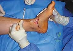 صورة طبية: القدم الحنفاء الجوفاء الروحاء دليلك الشامل للعلاج مع الأستاذ الدكتور محمد هطيف في صنعاء