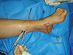 صورة طبية: القدم الحنفاء الجوفاء الروحاء دليلك الشامل للعلاج مع الأستاذ الدكتور محمد هطيف في صنعاء