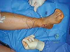 صورة طبية: القدم الحنفاء الجوفاء الروحاء دليلك الشامل للعلاج مع الأستاذ الدكتور محمد هطيف في صنعاء