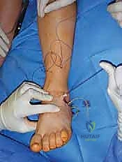 صورة طبية: القدم الحنفاء الجوفاء الروحاء دليلك الشامل للعلاج مع الأستاذ الدكتور محمد هطيف في صنعاء