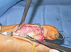 صورة طبية: القدم الحنفاء الجوفاء الروحاء دليلك الشامل للعلاج مع الأستاذ الدكتور محمد هطيف في صنعاء