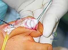 صورة طبية: القدم الحنفاء الجوفاء الروحاء دليلك الشامل للعلاج مع الأستاذ الدكتور محمد هطيف في صنعاء