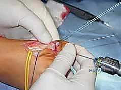 صورة طبية: القدم الحنفاء الجوفاء الروحاء دليلك الشامل للعلاج مع الأستاذ الدكتور محمد هطيف في صنعاء