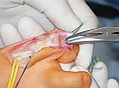 صورة طبية: القدم الحنفاء الجوفاء الروحاء دليلك الشامل للعلاج مع الأستاذ الدكتور محمد هطيف في صنعاء