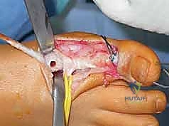 صورة طبية: القدم الحنفاء الجوفاء الروحاء دليلك الشامل للعلاج مع الأستاذ الدكتور محمد هطيف في صنعاء