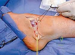 صورة طبية: القدم الحنفاء الجوفاء الروحاء دليلك الشامل للعلاج مع الأستاذ الدكتور محمد هطيف في صنعاء