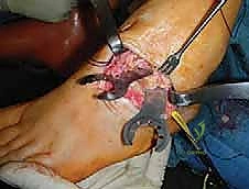 صورة طبية: القدم الحنفاء الجوفاء الروحاء دليلك الشامل للعلاج مع الأستاذ الدكتور محمد هطيف في صنعاء