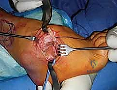 صورة طبية: القدم الحنفاء الجوفاء الروحاء دليلك الشامل للعلاج مع الأستاذ الدكتور محمد هطيف في صنعاء