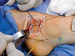 صورة طبية: القدم الحنفاء الجوفاء الروحاء دليلك الشامل للعلاج مع الأستاذ الدكتور محمد هطيف في صنعاء