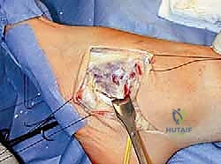 صورة طبية: القدم الحنفاء الجوفاء الروحاء دليلك الشامل للعلاج مع الأستاذ الدكتور محمد هطيف في صنعاء