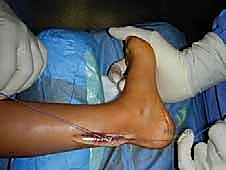 صورة طبية: القدم الحنفاء الجوفاء الروحاء دليلك الشامل للعلاج مع الأستاذ الدكتور محمد هطيف في صنعاء