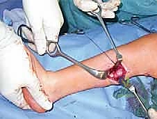 صورة طبية: القدم الحنفاء الجوفاء الروحاء دليلك الشامل للعلاج مع الأستاذ الدكتور محمد هطيف في صنعاء