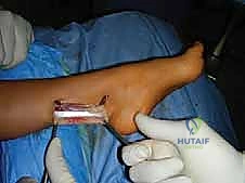 صورة طبية: القدم الحنفاء الجوفاء الروحاء دليلك الشامل للعلاج مع الأستاذ الدكتور محمد هطيف في صنعاء