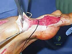 صورة طبية: القدم الحنفاء الجوفاء الروحاء دليلك الشامل للعلاج مع الأستاذ الدكتور محمد هطيف في صنعاء