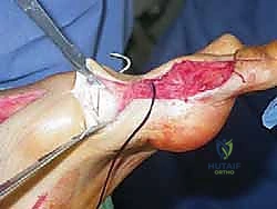 صورة طبية: القدم الحنفاء الجوفاء الروحاء دليلك الشامل للعلاج مع الأستاذ الدكتور محمد هطيف في صنعاء