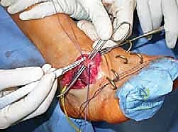 Masterclass: Surgical Correction of Equinocavovarus Foot Deformity