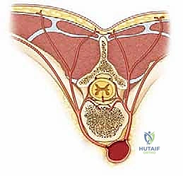 صورة توضيحية لـ التعرض الخلفي للعمود الفقري لتصحيح الجنف: دليل شامل للمرضى مع الأستاذ الدكتور محمد هطيف