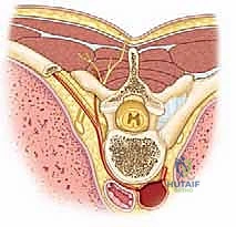 التشوه ثلاثي الأبعاد للعمود الفقري في حالات الجنف